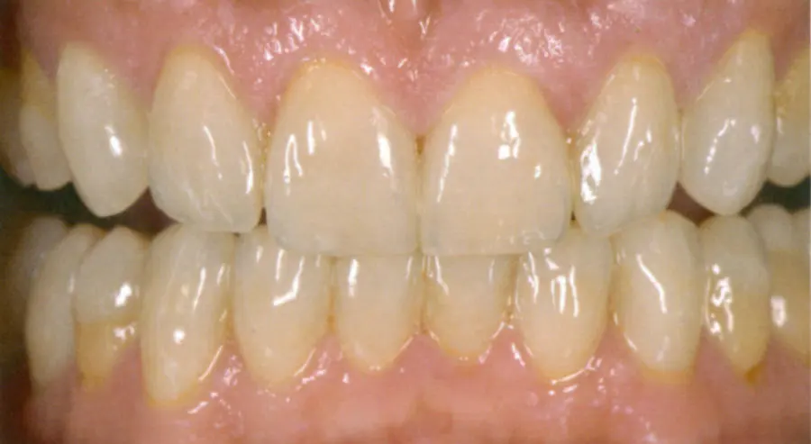 Ergebnis nach der Behandlung